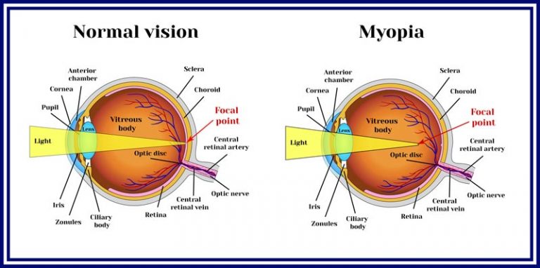 Myopia - Oneway Eyeglasses - Greenville, South Carolina